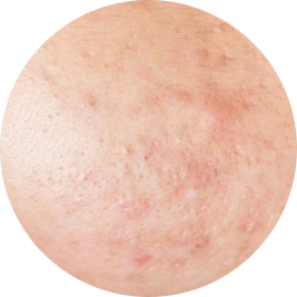 اسکار آتروفیک