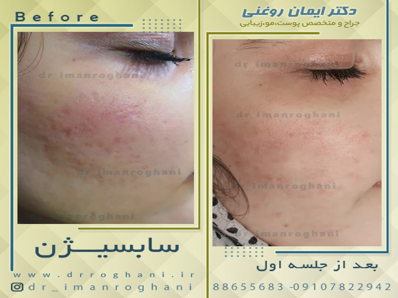 عکس قبل و بعد از سابسیژن