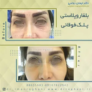 بلفاروپلاستی