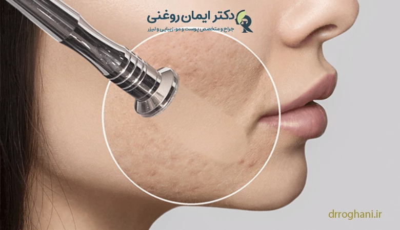 میکرودرم ابریژن چیست؟