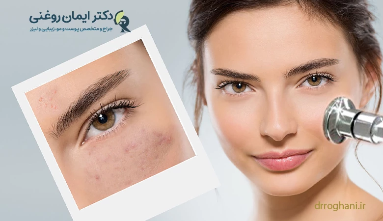 چگونگی انجام میکرودرم ابریژن