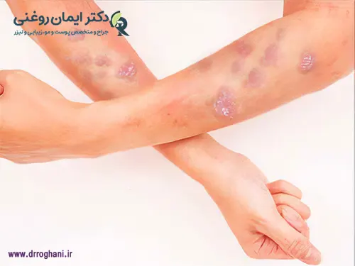 درمان لیکن پلان