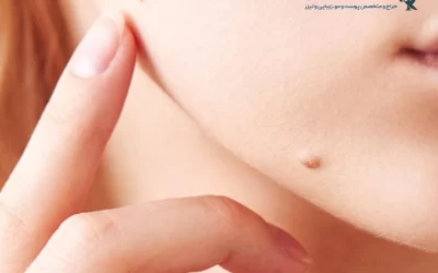 درمان قطعی زگیل پوستی؛ سریع، بدون درد و بازگشت