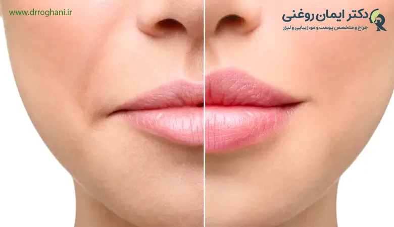 مراقبتهای لازم برای کاهش عوارض تزریق ژل لب مراقبتهای لازم برای کاهش عوارض تزریق ژل لب