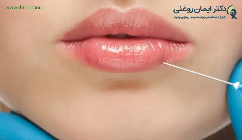 چگونه عوارض تزریق ژل لب را تشخیص دهیم؟ چگونه عوارض تزریق ژل لب را تشخیص دهیم؟