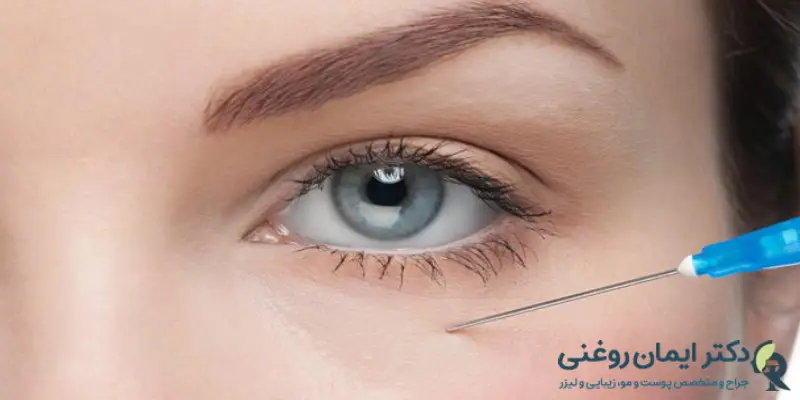مراقبت_های بعد از تزریق ژل زیر چشم شامل چه مواردی است؟ مراقبت_های بعد از تزریق ژل زیر چشم شامل چه مواردی است؟