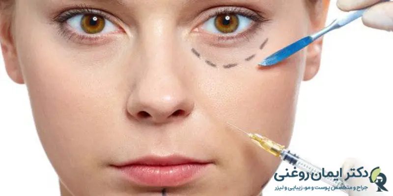 مراقبت_های بعد از تزریق ژل زیر چشم و ورزش مراقبت_های بعد از تزریق ژل زیر چشم و ورزش