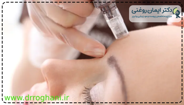 مراقبتهای بعد از مزوتراپی لک صورت