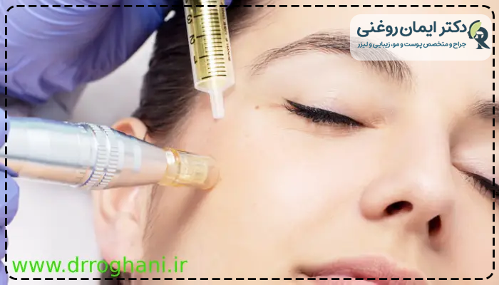 مزوتراپی صورت برای لک