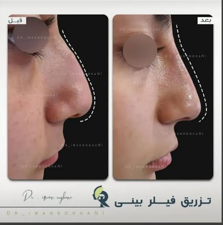 تزریق فیلر برای چه کسانی مناسب است؟