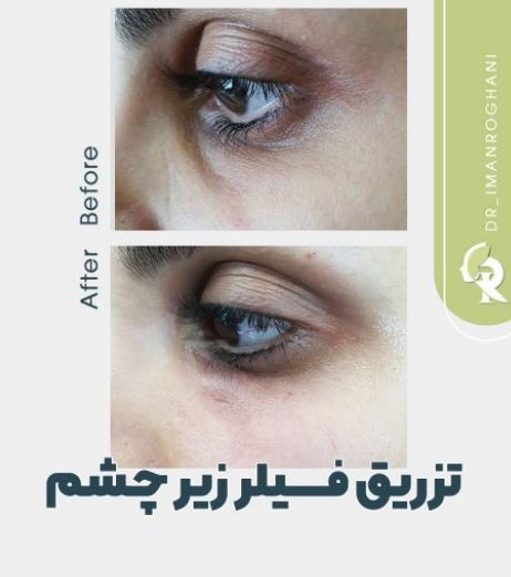 تزریق فیلر برای چه کسانی مناسب نیست؟
