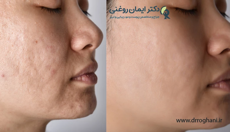 چگونه از عوارض سابسیژن پیشگیری کنیم؟